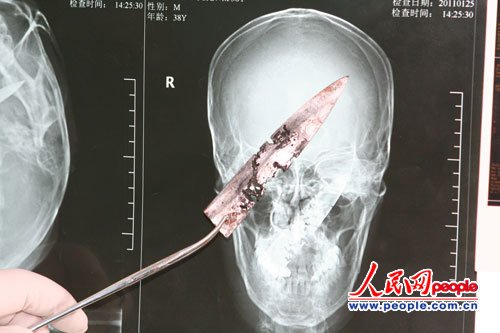 云南一村民颅内藏刀4年奇迹存活(图)