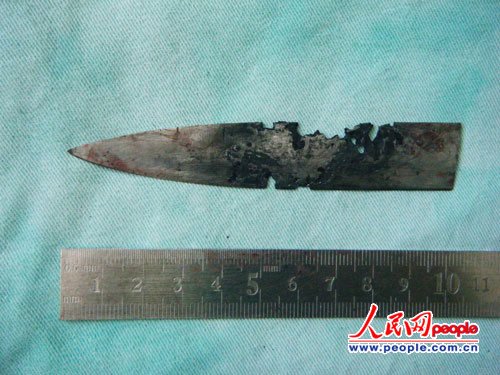 云南一村民颅内藏刀4年奇迹存活(图)